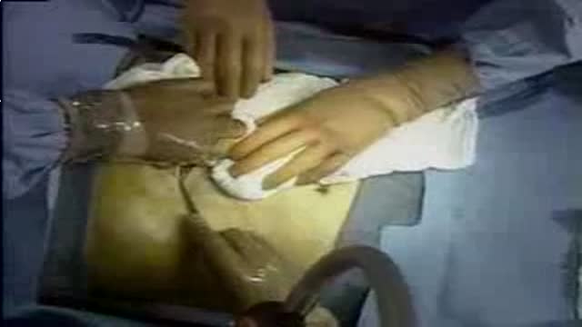 Open Distal Pancreatectomy Surgery Video