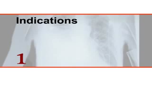  Thoracentesis