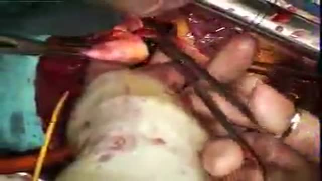 Heart Transplant Video