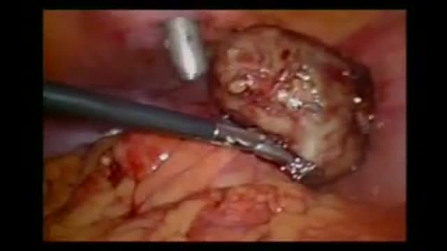 ⁣Laparoscopic Salpengectomy of a torted Fallopian Tube