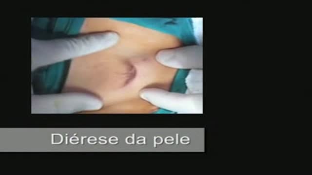 Umbilical hernia repair Surgery