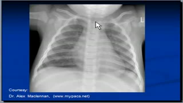 ⁣Chest x-ray --congenital lobar emphysema