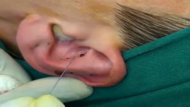 ⁣Bat Ears Correction Plastic Surgery