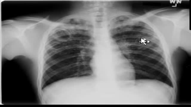 Chest x-ray --Tuberculosis