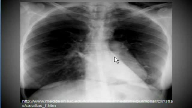 chest x-ray --Pneumomediastinum