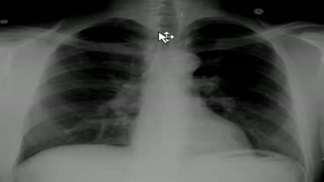 Chest x-ray -- Histoplasmosis