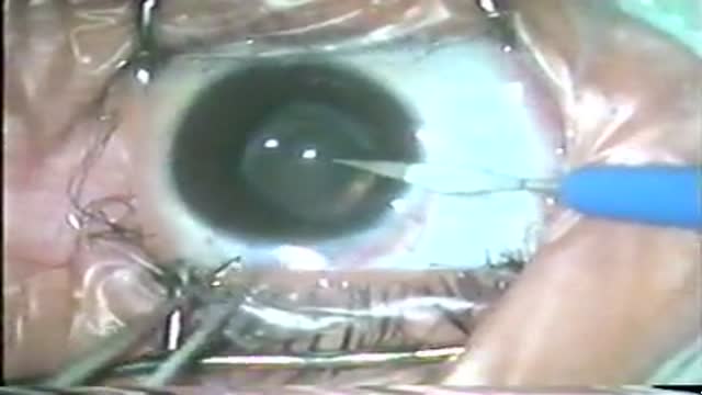 ⁣Secondary Cataract
