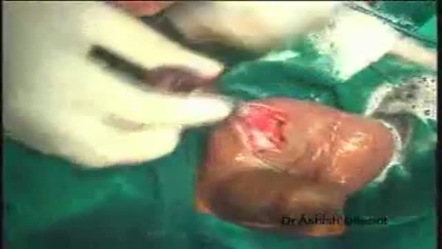 Orchidectomy and Orchidopexy in Testicular Torsion