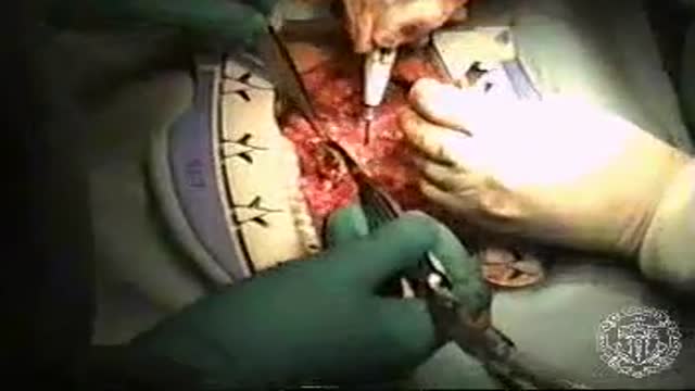 Coronary Artery Bypass Grafting CABG