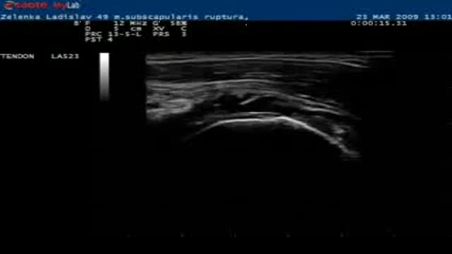 ultrasound shoulder