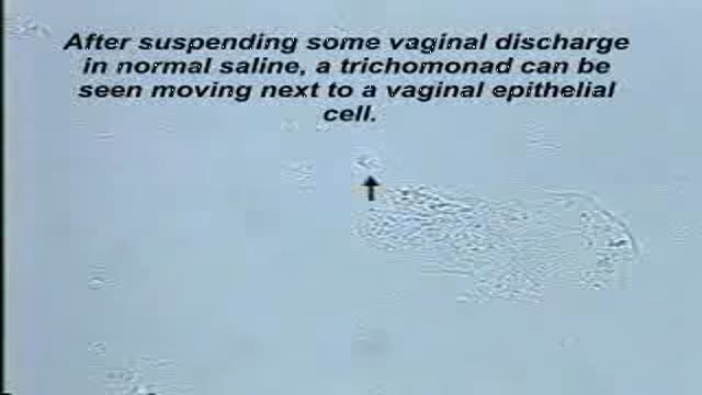 ⁣Trichomonas Vaginalis