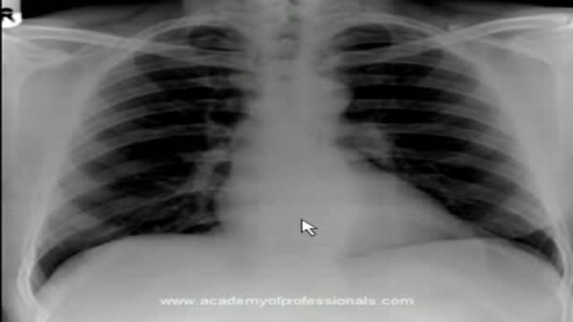 chest x-ray, artificial aortic and mitral valves