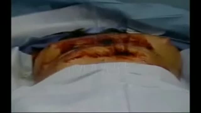 Breast Augmentation Plastic Surgery Video performed by Board Certified Surgeon