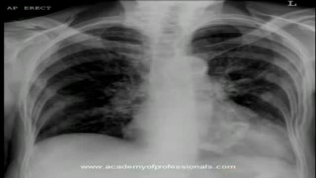 chest x-ray, mitral valve calcification