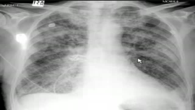 chest x-ray, pulmonary edema