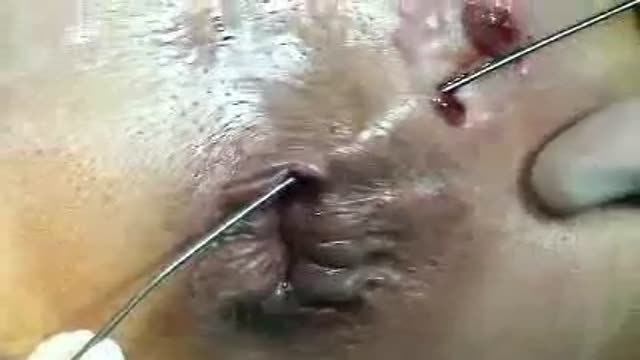 Fistulotomy Surgery Video