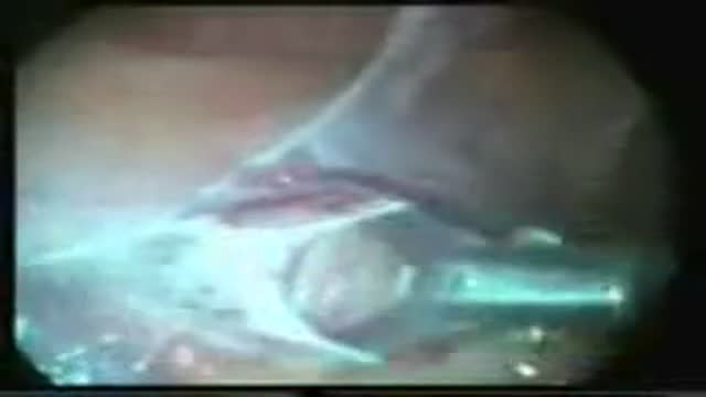 Laparoscopic varicocellectomy Varicocele Surgery
