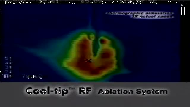 Cool-tip (TM) Radiofrequency Ablation System