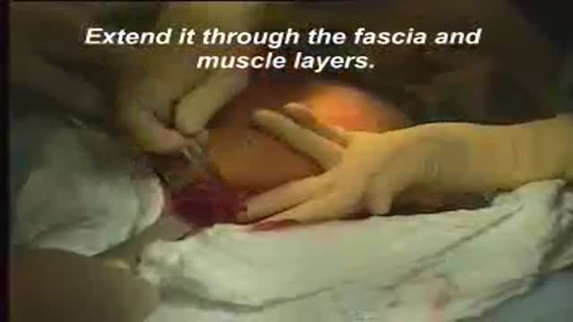 Cesarean Section Delivery