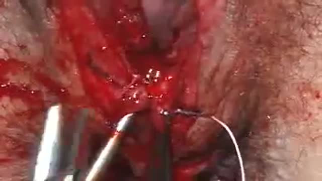 Episiotomy Repair