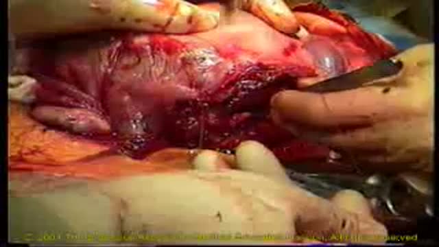 ⁣Suturing of Uterus
