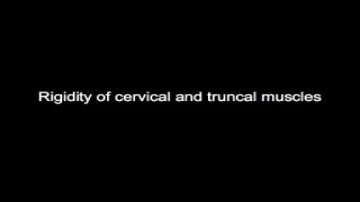 ⁣Tetanus signs and symptoms