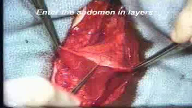 ⁣Hysterectomy