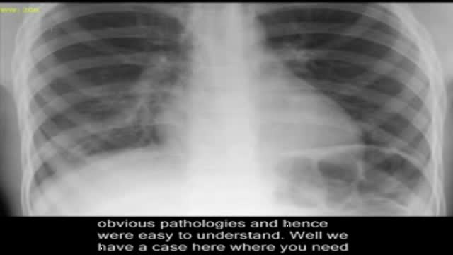 Pneumonia, on chest x-ray.