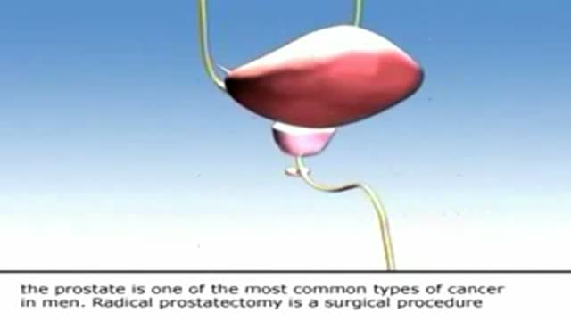 Radical Prostatectomy