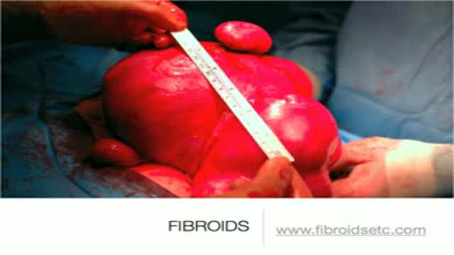 Uterine Fibroid Tumors (Leiomyomas)