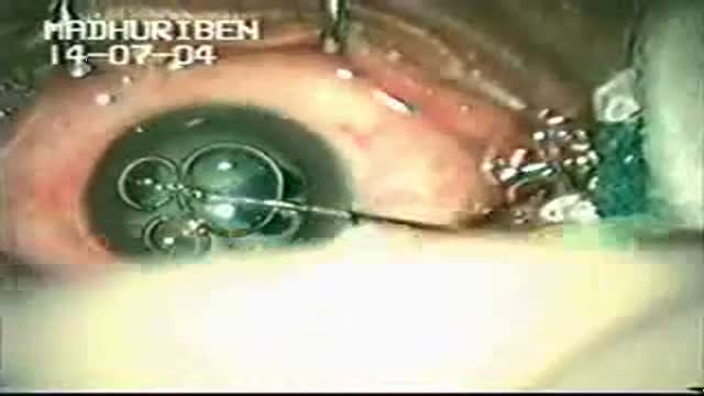 ⁣Hypermature cataract Phacoemulsification using Trypan Blue