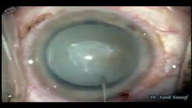 ⁣Very Hard White Cataract with trypan blue Capsule Staining