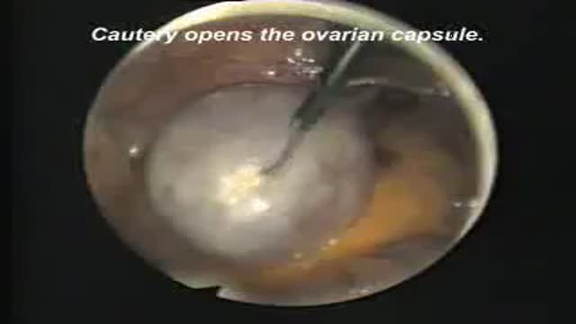 Ovarian Cystectomy