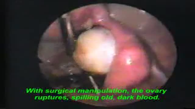 Chocolate Cyst of the Ovary