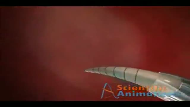 Heart Valve Surgery Animation