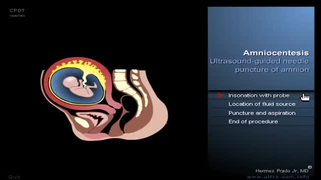 Amniocentesis Ultrasound Guided