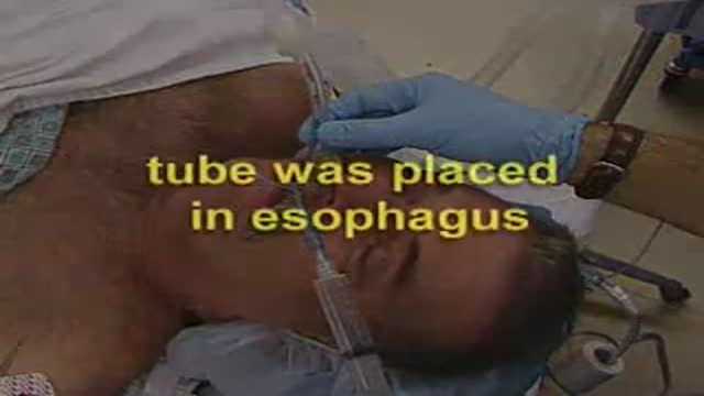 ⁣Esophageal Intubation