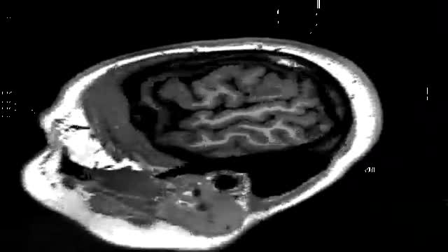 MRI of the brain