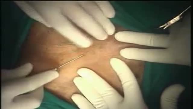 Hernia Repair with Prolene Hernia System