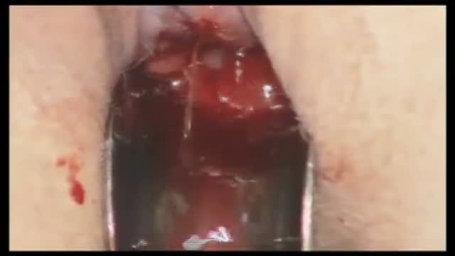 Abortion Surgery Video