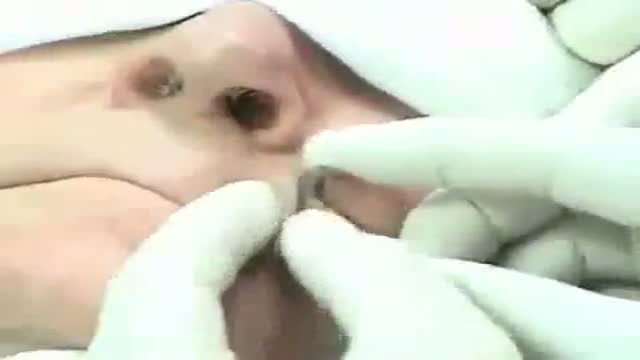Mohs Surgery Procedure Demonstrated