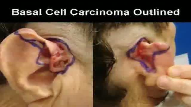 ⁣Ear Reconstruction After Skin Cancer Surgery