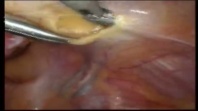 Laparoscopic inguinal hernia repair