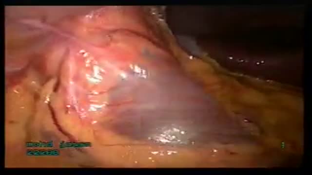 Laparoscopic Abdominal Wall Hernia Repair