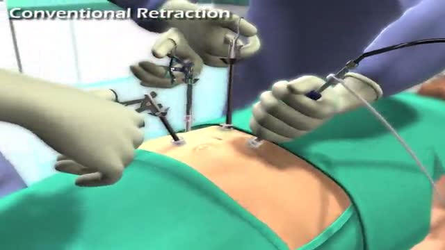 Laparoscopic procedures, EndoGrab (Virtual Ports)