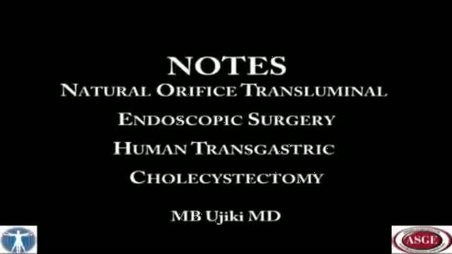 Transgastric Cholecystectomy