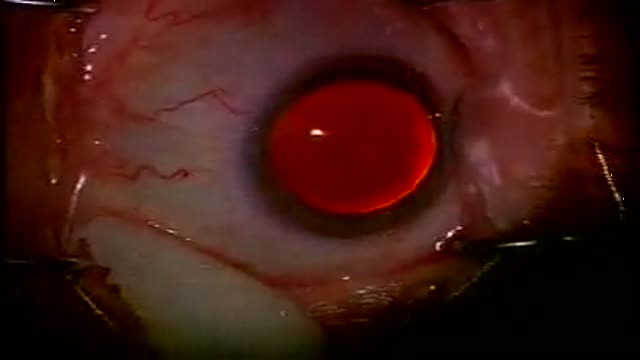 ⁣Cataract Surgery 3