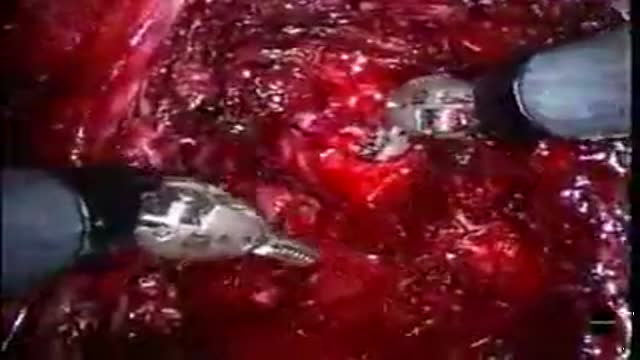 ⁣Robotic anastomosis of bladder to urethra