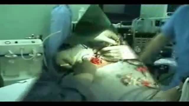 Total Thyroidectomy Surgery Video