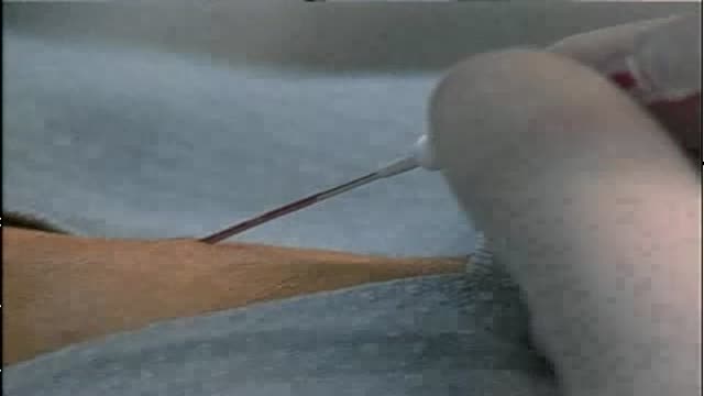 Radial Artery Catheterization Procedure